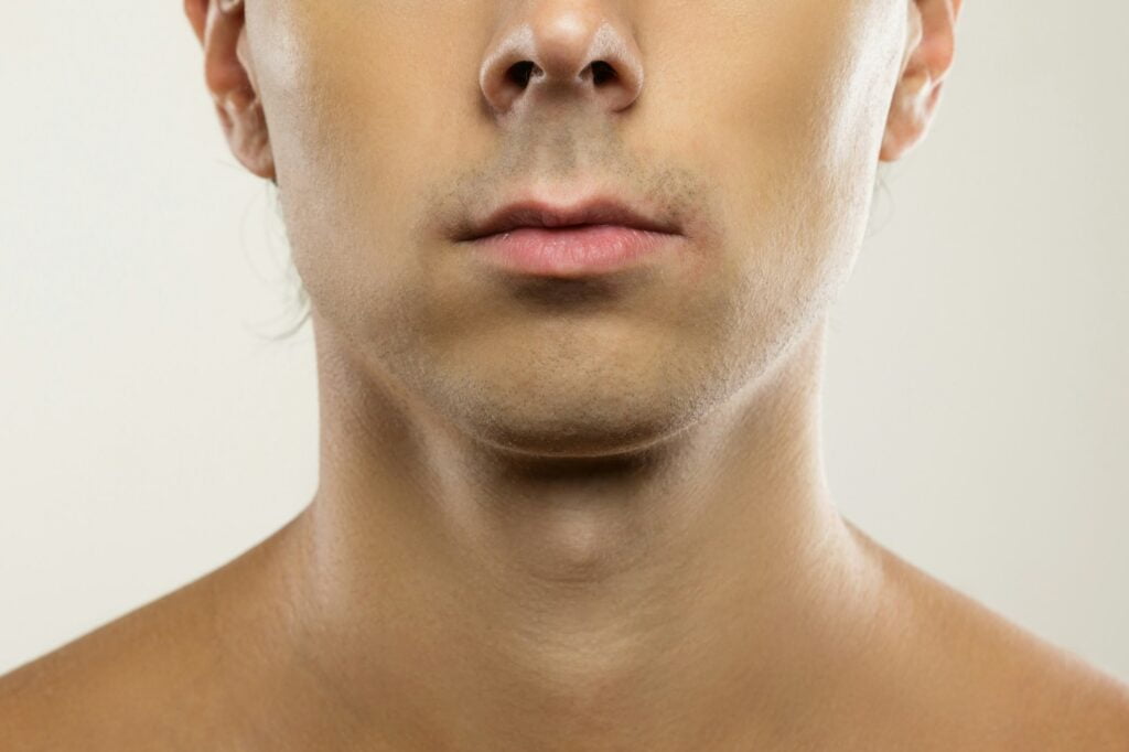 Surgery or mewing exercises. Result of a jawline reshape.